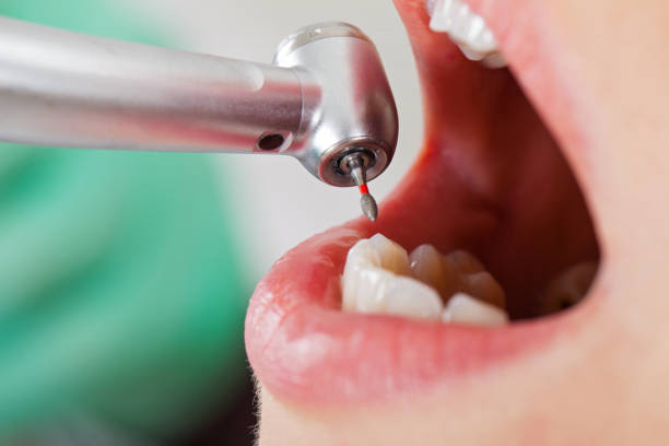 Best Emergency Root Canal Treatment in Belle Plaine, IA